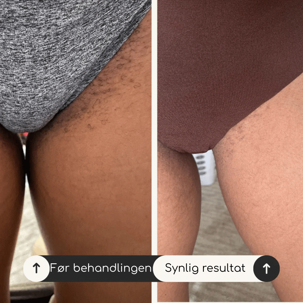 Sanovia™ Intim Antibakteriell Krem Lindrer 98 % av intim kløe på bare 3 dager