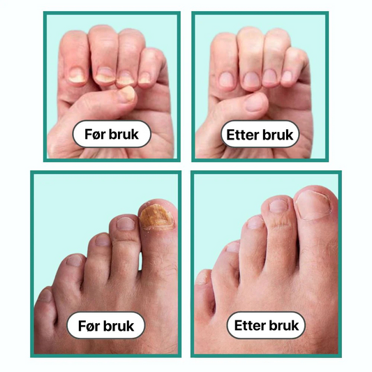 Sanovia® - NAILCURE PRO | APPARAT MOT NAGELSVAMP