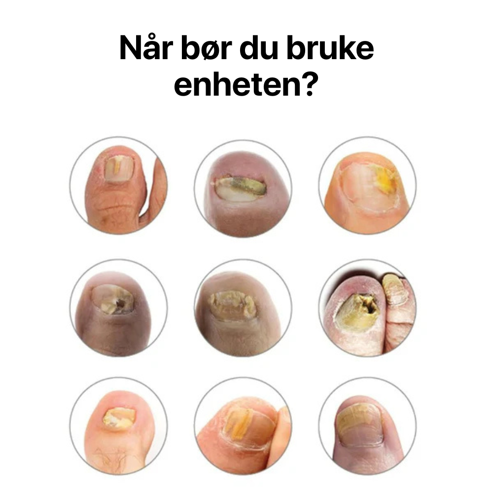 Sanovia® NailCure Max | KLINISK DOKUMENTERT ENHET MOT NEGLESOPP
